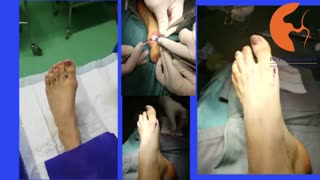 عمل جراحی هالوکس والگوس