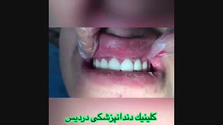 کامپوزیت دندان برای اصلاح طرح لبخند