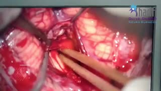 چکاپ پارسا کوچولو یکسال بعد از جراحی تومور مغزی توسط دکتر گیو شریفی