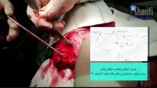 فیلم جراحی خارج کردن تومور مغزی توسط دکتر گیو شریفی