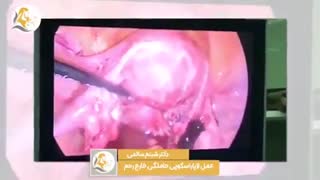 لاپاراسکوپی حاملگی خارج رحم در لوله رحم