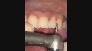 تراش دندان برای لمینت