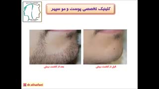 کاشت ریش و سبیل