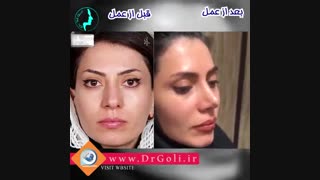 شش سال بعد از عمل بینی | دکتر گلی