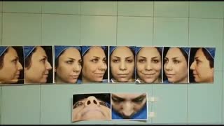 عمل بینی گوشتی | دکتر ابراهیمی جراح بینی تهران