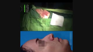 جراحی بینی استخوانی با قوز و شکل گیری نامتقارن | دکتر باستانی نژاد