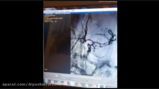 آنژیوگرافی شریان مغزی میانی به کمک استنت و کاتتر