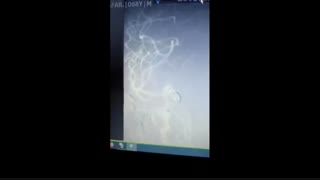 درمان آنوریسم مغزی به روش استنت و کویل گذاری