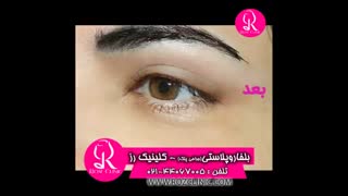 فیلم بلفاروپلاستی | کلینیک رز | 09104440228 | شماره 6