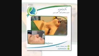 فیلم نمونه جراحی بینی دکتر انصاریپور