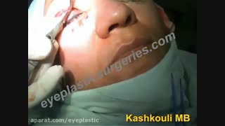فیلم عمل جراحی پلک بالا و خط اخم | پروفسور کشکولی