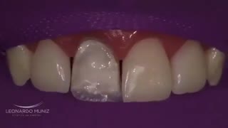بازسازی دندان شکسته جلو