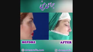 قبل و بعد از جراحی بینی | جراح بینی تهران دکتر رفیع