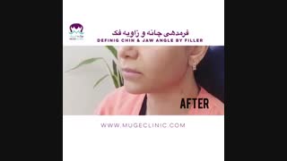 فرم دهی چانه و زاویه فک