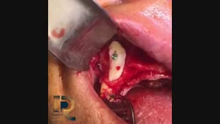 پیوند استخوان اتوژن