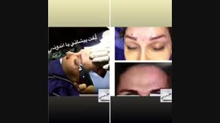 لیفت اندوسکوپی پیشانی