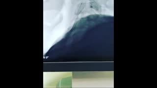 سکته مغزی و عمل جراحی بای پس عروق کرونری CABG