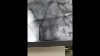 آنژیوگرافی و انژیوپلاستی شریان ورتبرال