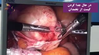 جراحی لاپاراسکوپی