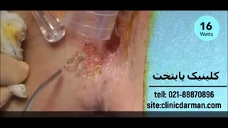 درمان زگیل تناسلی با لیزر، کرایوتراپی و الکتروکوتر - کلینیک پایتخت