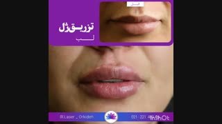 تزریق ژل لب در کلینیک ارکیده
