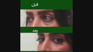 بلفاروپلاستی پلک کاشت ابرو