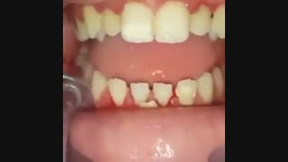 جرمگیری دندان