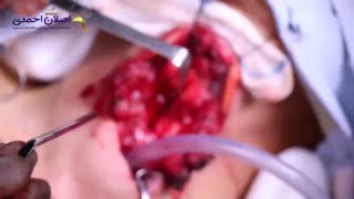 جراحی سرطان حنجره