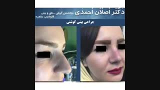 نمونه های جراحی بینی دکتر اصلان احمدی