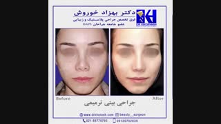 فیلم جراحی بینی ترمیمی