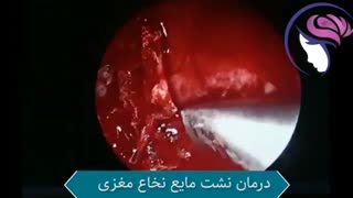 درمان مایع نشت نخاعی مغزی