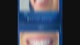 کامپوزیت ونیر تزریق ژل