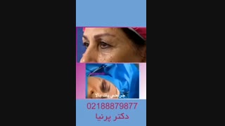 لیفت صورت در تهران