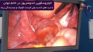 لاپاروسکوپی آندومتریوز در خانم جوان