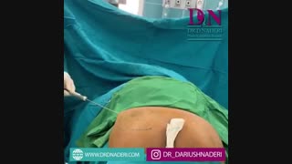 تزریق چربی به باسن عمل زیبایی