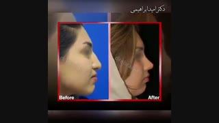 نمونه جراحی‌های زیبایی بینی  توسط دکتر امید ابراهیمی بهترین جراح بینی