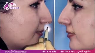 عمل بینی توسط دکتر کاوان