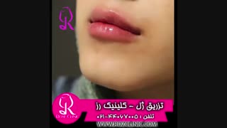 فیلم تزریق ژل | کلینیک رز | 09104440228 | شماره 180