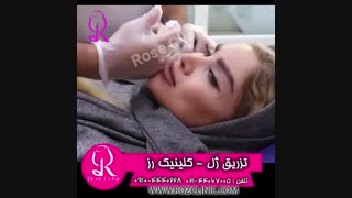 فیلم تزریق ژل | کلینیک رز | 09104440228 | شماره 181