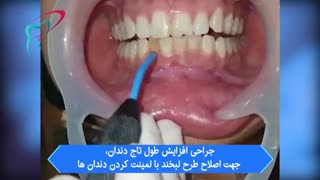 جراحی افزایش طول تاج دندان
