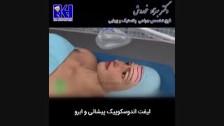 انیمیشن لیفت اندوسکوپیک پیشانی و ابرو