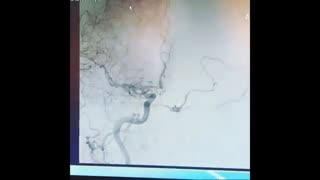 بستن فیستول شریان کاروتید و کاورنوس سینوس CCF