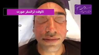 نمونه تزریق نانوفت هایفوتراپی