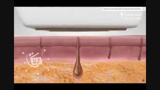 لیزر بیکینی