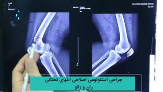 فیلم جراحی استئوتومی زانو