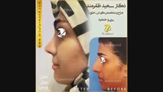 نمونه کار جراحی بینی دکتر سعید ظفرمند