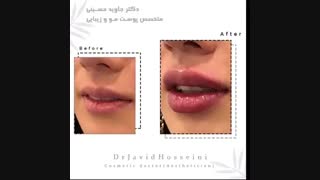 فیلم تزریق ژل لب