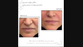 فیلم تزریق خط خنده