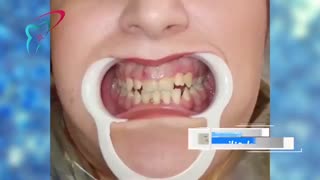 افزایش طول تاج لثه