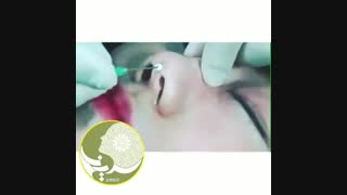 لیفت بینی با نخ